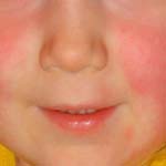 County Council Issue Advice About Scarlet Fever For Parents