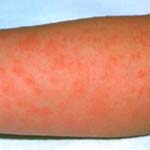 Council Issues Advice About Scarlet Fever As Cases Increase